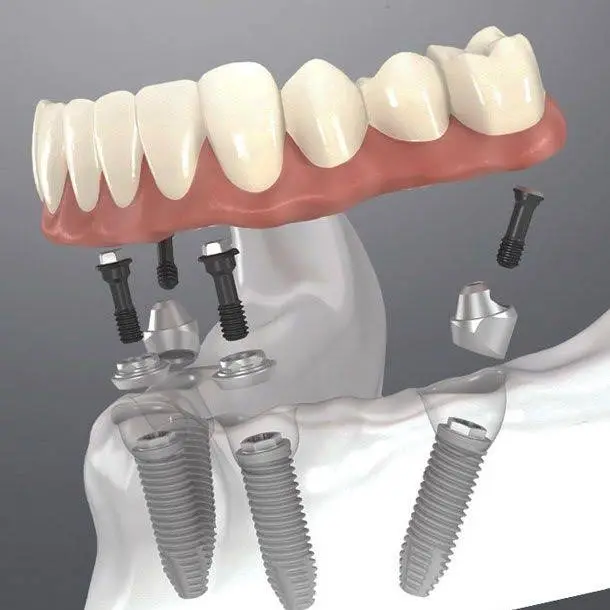 Stubbs Dental Implant Center