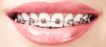 Braces Las Vegas