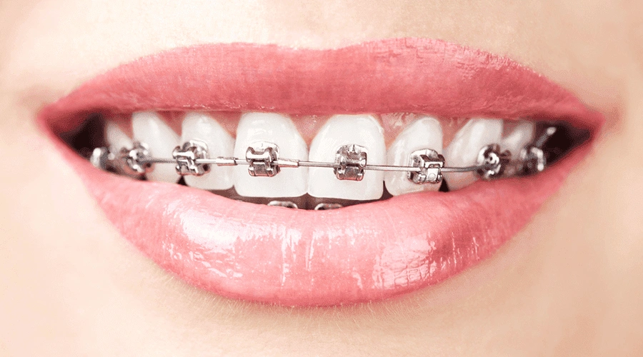 Braces Las Vegas - Professional dental clinic exterior with modern facilities