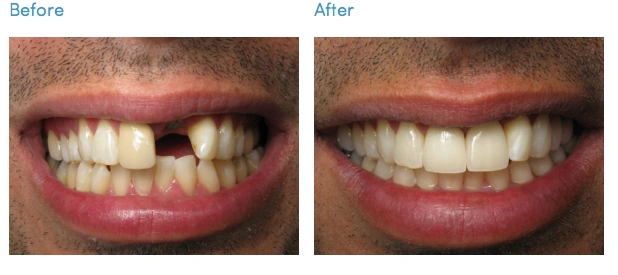 ChewsWisely Dental Implant Center