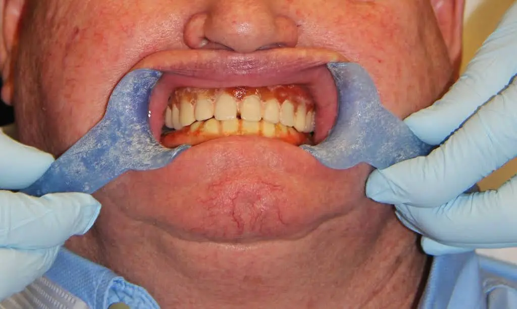 G4 Dental Implants