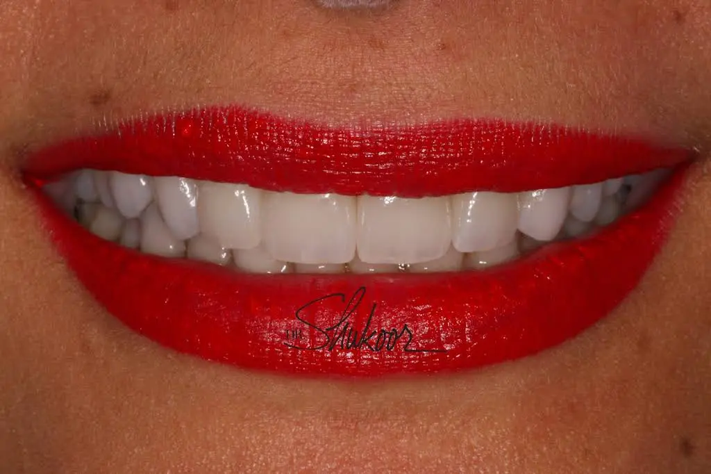 DC Same Day Dental Crowns