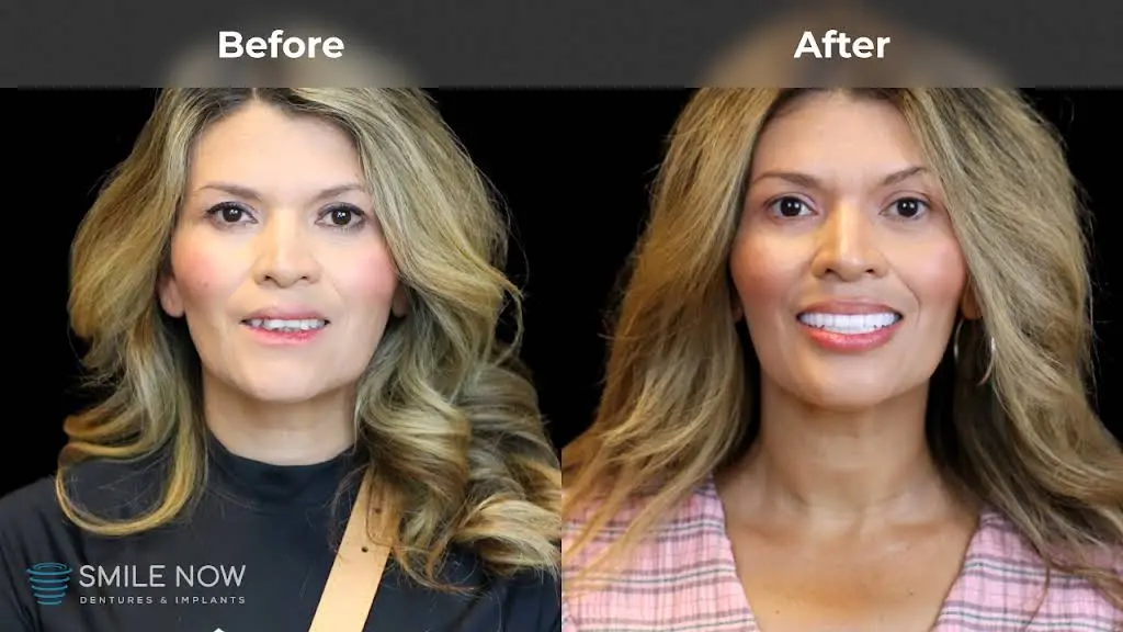 Smile Now Milwaukee Dentures and Implants