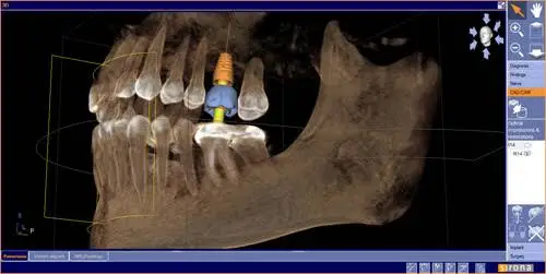 Carolina Implant