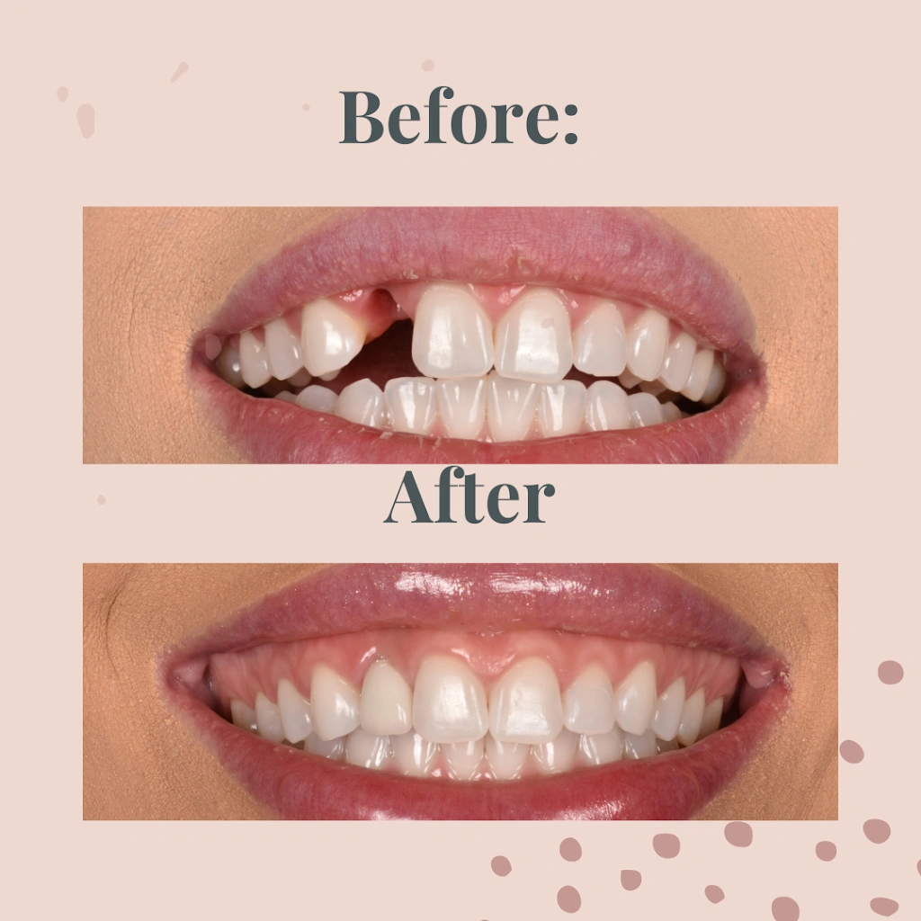 All On Implants and Modern Dentistry