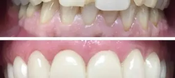 NÜVA SMILE
