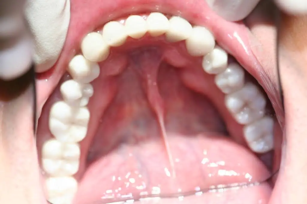 Hollywood Smile