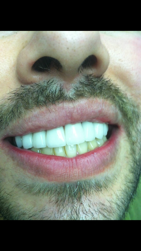 Hollywood Smile