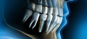 Melillo Dental Associates