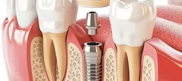 Aurora Smiles - Dr. Amul G. Patel, DDS P.C