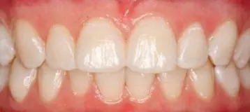 12 Month Smiles