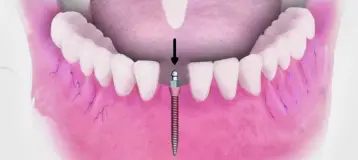 Keep Smiling Hartford Dental Implant Center