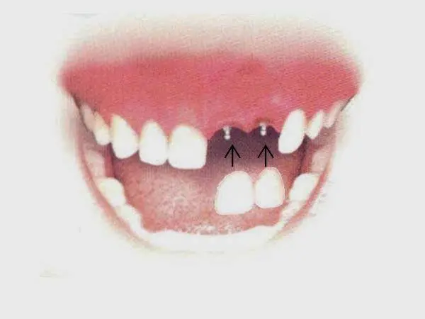 Keep Smiling Hartford Dental Implant Center