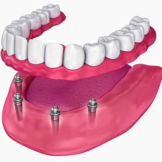 Signature Smiles Family & Implant Dentistry