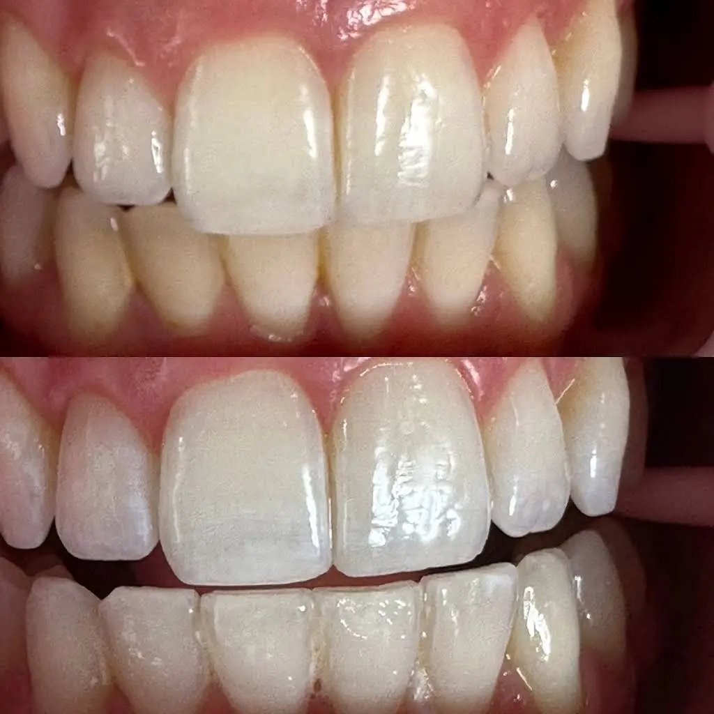 Luxe Teeth Whitening CT