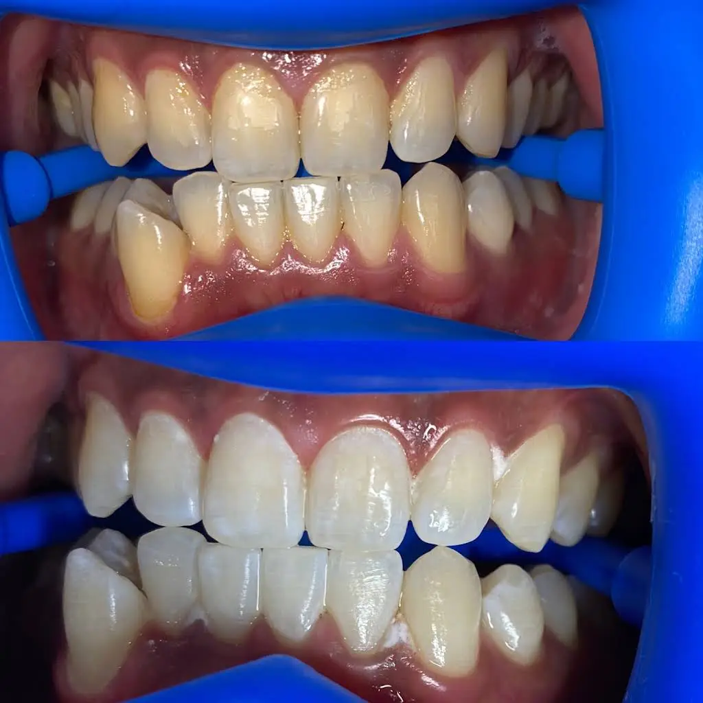 Luxe Teeth Whitening CT