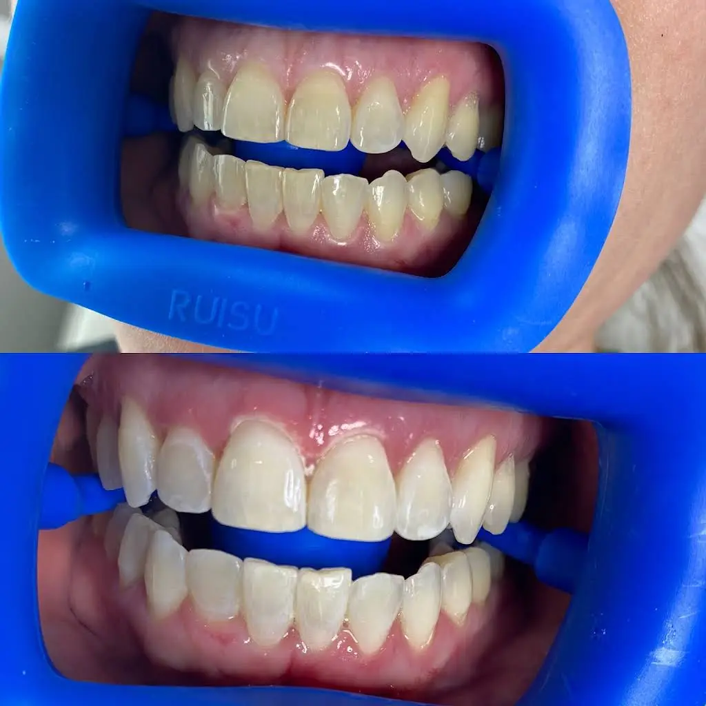 Luxe Teeth Whitening CT