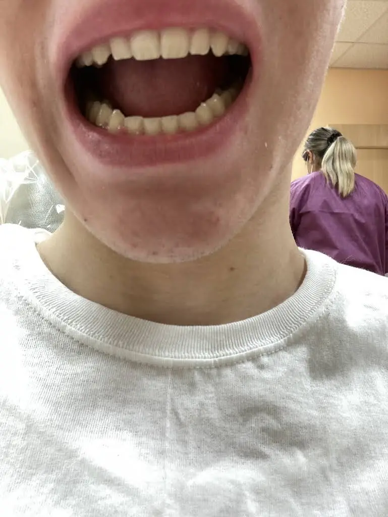Lowell Braces