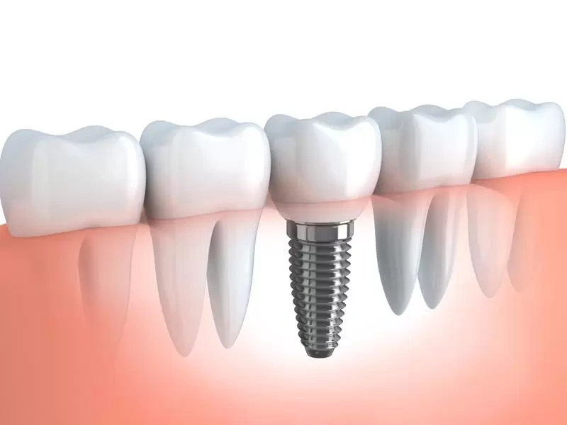 Atwood Advanced Dentistry