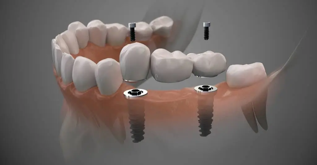 Memphis Dentures and Implants