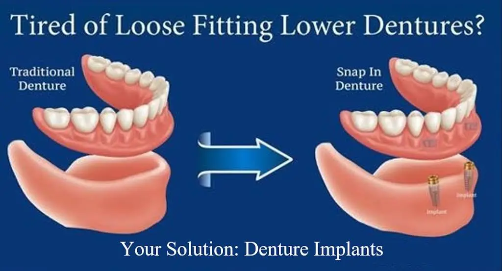Affordable Dentures & Implants