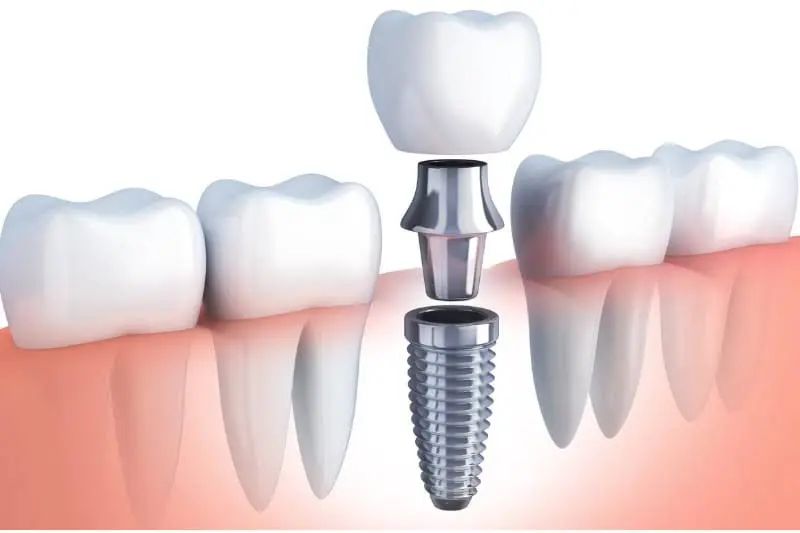 Desoto Dentures and Implants