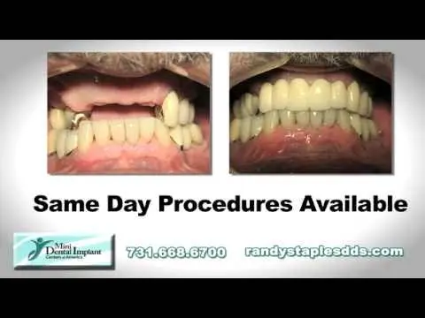 Randy Staples, DDS - Mini Implants Jackson