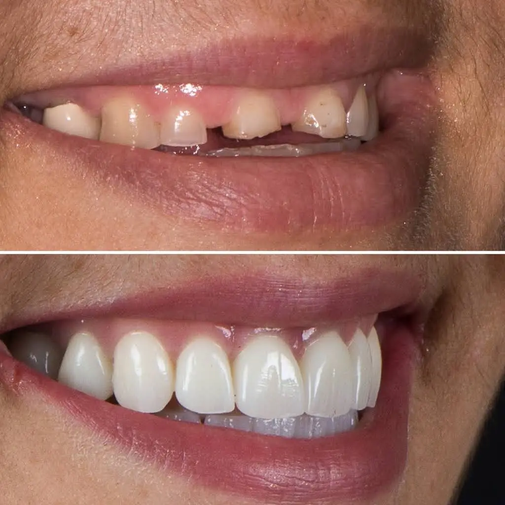 Advanced Prosthodontics & Implant Esthetics