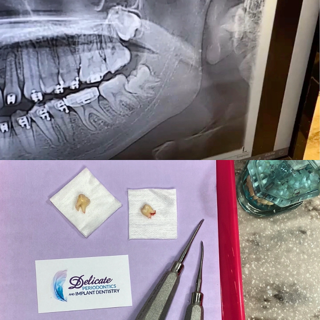 Delicate Periodontics and Implant Dentistry