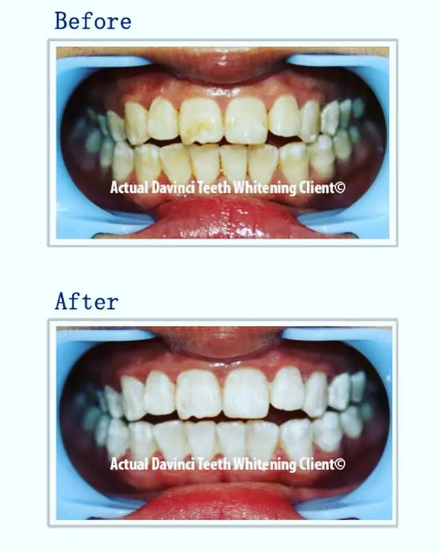 DaVinci Teeth Whitening Of SW Florida