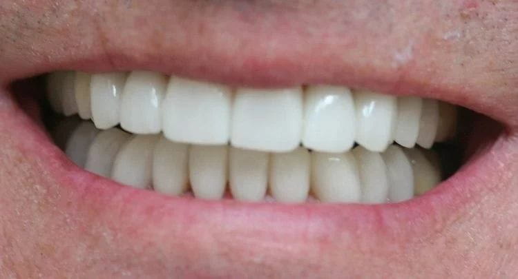 Crown Dentistry of the Palm Beaches