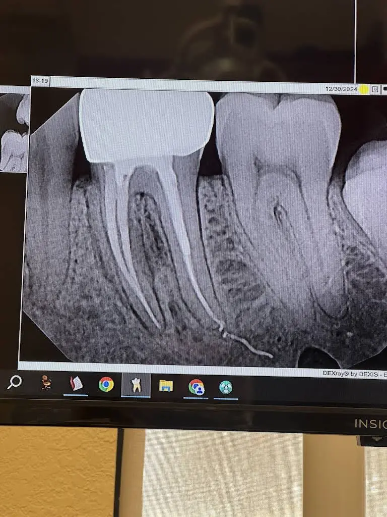 Laser Endodontics