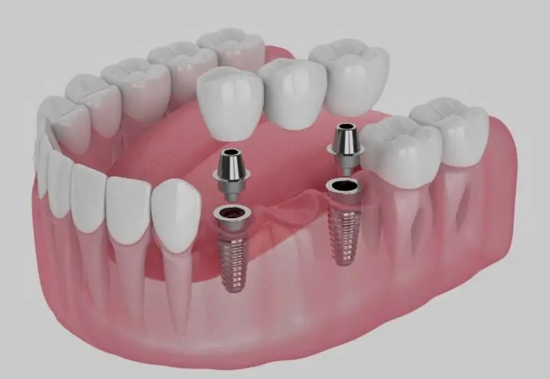 Apex Dentistry - Fort Pierce