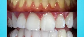 Flawless Teeth Whitening