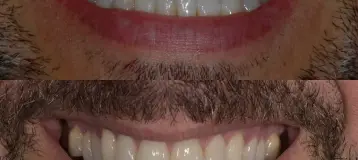 Innovative Dental Aesthetics of Boca Raton