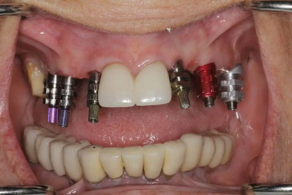 Restorative and Implant Dentistry Pompano Beach