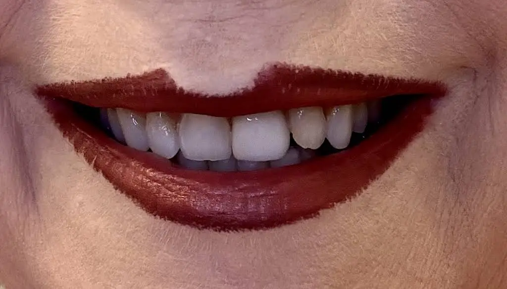 Hollywood Perfect Smile