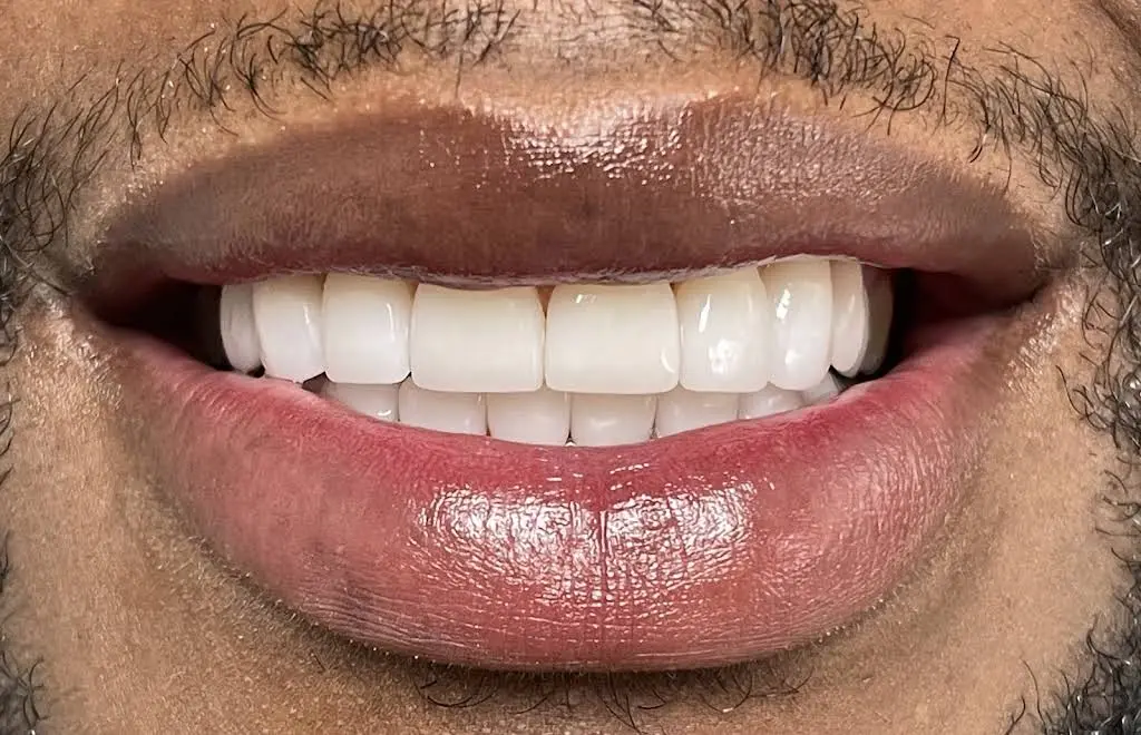 Hollywood Perfect Smile