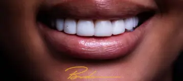 Billion Dollar Smile - Elite Smile Makeovers