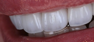 Miami Veneers and Modern Dentistry