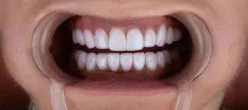 Smile Design Miami