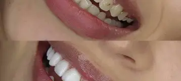 Kendall iSmile & Braces