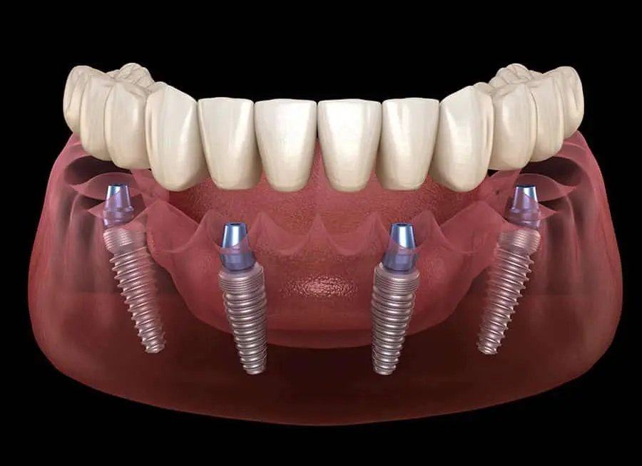 Advanced Family Dental Kendall