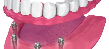 Best Value Dentures and Implants Palmetto Bay