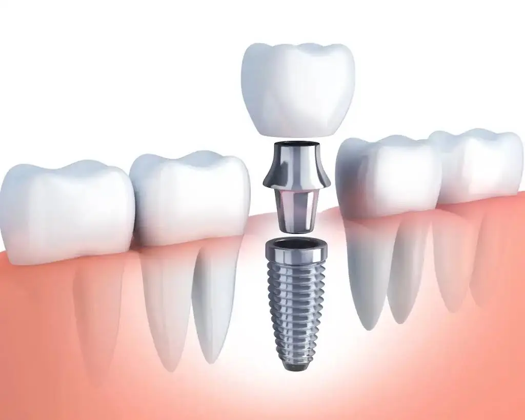 Best Value Dentures and Implants Palmetto Bay
