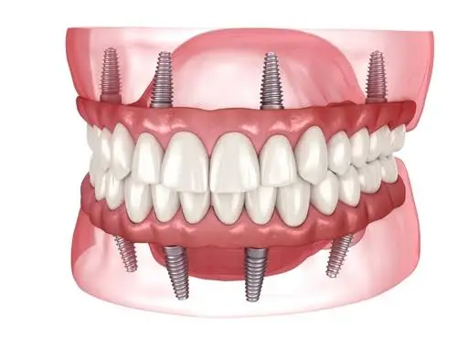 Best Value Dentures and Implants Palmetto Bay