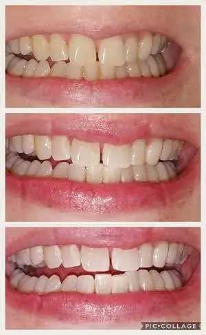 Tallahassee SmileLabs Teeth Whitening