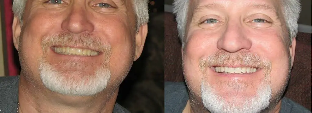 Tallahassee SmileLabs Teeth Whitening