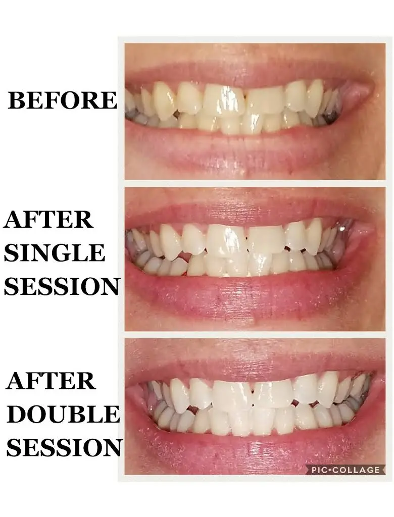 Tallahassee SmileLabs Teeth Whitening